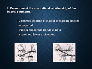 2.2. Correction of the mesiodistal relationship of theCorrection of the mesiodistal relationship of the
buccal segmentsbuccal segments..
- Continual wearing of class II or class III elastics- Continual wearing of class II or class III elastics
as required.as required.
- Proper anchorage bends in both- Proper anchorage bends in both
upper and lower arch wires.upper and lower arch wires.
 