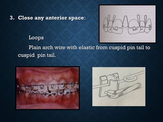 3.3. Close any anterior spaceClose any anterior space::
LoopsLoops
Plain arch wire with elastic from cuspid pin tail toPlain arch wire with elastic from cuspid pin tail to
cuspid pin tail.cuspid pin tail.
 