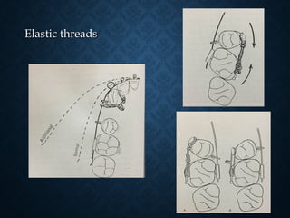 Elastic threadsElastic threads
 