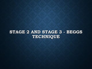 STAGE 2 AND STAGE 3 - BEGGSSTAGE 2 AND STAGE 3 - BEGGS
TECHNIQUETECHNIQUE
 