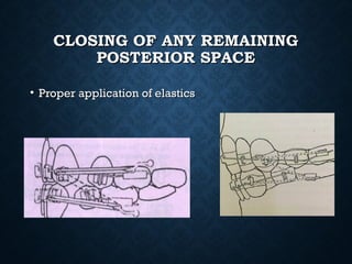 CLOSING OF ANY REMAININGCLOSING OF ANY REMAINING
POSTERIOR SPACEPOSTERIOR SPACE
• Proper application of elasticsProper application of elastics
 