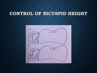 CONTROL OF BICUSPID HEIGHTCONTROL OF BICUSPID HEIGHT
 