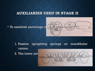 AUXILIARIES USED IN STAGE IIAUXILIARIES USED IN STAGE II
• To establish anchorage in the anterior segment..To establish anchorage in the anterior segment..
1.1. Passive uprighting springs on mandibularPassive uprighting springs on mandibular
canine.canine.
2.2. The lower anterior braking archesThe lower anterior braking arches
 