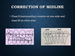 CORRECTION OF MIDLINECORRECTION OF MIDLINE
• Class II intermaxillary elastics on one side andClass II intermaxillary elastics on one side and
class III on other side.class III on other side.
 