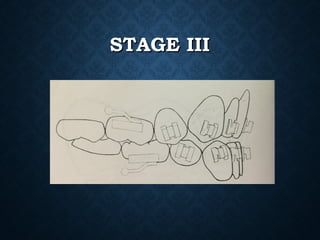 STAGE IIISTAGE III
 