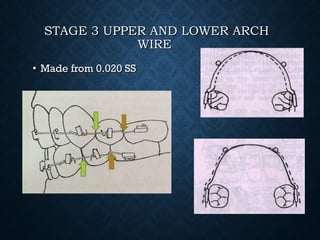 STAGE 3 UPPER AND LOWER ARCHSTAGE 3 UPPER AND LOWER ARCH
WIREWIRE
• Made from 0.020 SSMade from 0.020 SS
 