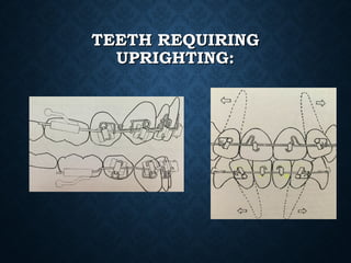 TEETH REQUIRINGTEETH REQUIRING
UPRIGHTING:UPRIGHTING:
 