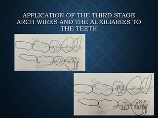 APPLICATION OF THE THIRD STAGEAPPLICATION OF THE THIRD STAGE
ARCH WIRES AND THE AUXILIARIES TOARCH WIRES AND THE AUXILIARIES TO
THE TEETHTHE TEETH
 