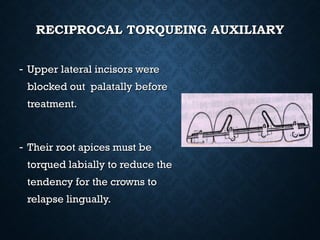 RECIPROCAL TORQUEING AUXILIARYRECIPROCAL TORQUEING AUXILIARY
- Upper lateral incisors wereUpper lateral incisors were
blocked out palatally beforeblocked out palatally before
treatment.treatment.
- Their root apices must beTheir root apices must be
torqued labially to reduce thetorqued labially to reduce the
tendency for the crowns totendency for the crowns to
relapse lingually.relapse lingually.
 
