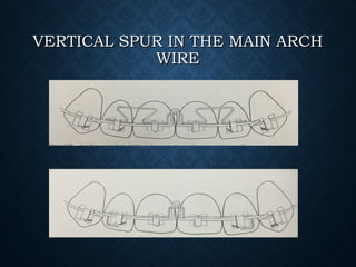 VERTICAL SPUR IN THE MAIN ARCHVERTICAL SPUR IN THE MAIN ARCH
WIREWIRE
 