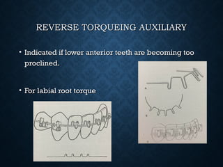 REVERSE TORQUEING AUXILIARYREVERSE TORQUEING AUXILIARY
• Indicated if lower anterior teeth are becoming tooIndicated if lower anterior teeth are becoming too
proclined.proclined.
• For labial root torqueFor labial root torque
 