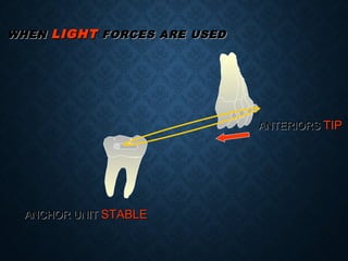 WHENWHEN LIGHTLIGHT FORCES ARE USEDFORCES ARE USED
ANCHOR UNITANCHOR UNIT STABLESTABLE
ANTERIORSANTERIORS TIPTIP
 