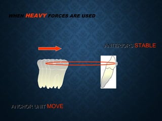 WHEN HEAVY FORCES ARE USED
ANCHOR UNITANCHOR UNIT MOVEMOVE
ANTERIORSANTERIORS STABLESTABLE
 