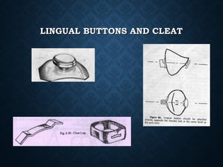 LINGUAL BUTTONS AND CLEATLINGUAL BUTTONS AND CLEAT
 