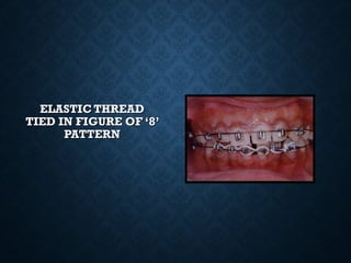 ELASTIC THREADELASTIC THREAD
TIED IN FIGURE OF ‘8’TIED IN FIGURE OF ‘8’
PATTERNPATTERN
 