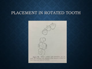 PLACEMENT IN ROTATED TOOTHPLACEMENT IN ROTATED TOOTH
 