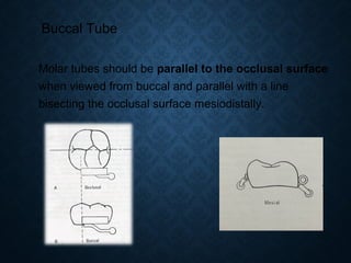 Buccal Tube
Molar tubes should be parallel to the occlusal surface
when viewed from buccal and parallel with a line
bisecting the occlusal surface mesiodistally.
 