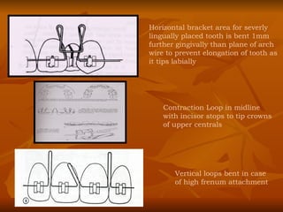 Horizontal bracket area for severly lingually placed tooth is bent 1mm further gingivally than plane of arch wire to prevent elongation of tooth as it tips labially Contraction Loop in midline with incisor stops to tip crowns of upper centrals Vertical loops bent in case of high frenum attachment 
