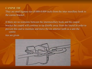 CANINE TIE They are steel ligature ties (0.008-0.009 inch) from the inter maxillary hook to  the canine bracket If there are no restraints between the intermaxillary hook and the cuspid  bracket the cuspid will continue to tip distally away from the lateral.In order to prevent this and to maintain and move the six anterior teeth as a unit the canine  ties are given 
