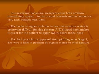Intermaxillary hooks are incorporated in both archwire immediately mesial  to the cuspid brackets and in contact or very near contact with them The hooks in upper arch has to bear two elastics which is somewhat difficult for ring pattern. A ‘Z’ shaped hook makes it easier for the patient to apply two rubbers to the hook The 2nd premolar is bypassed from pinning as in Stage I, The wire is held in position by bypass clamp or steel ligature 