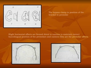 The bypass clamp in position of the bracket in premolar Slight horizontal offsets are formed distal to canines to maintain correct buccolingual position of the premolars and canines-they are the  premolar offsets 