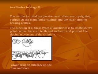 Auxiliaries in stage II: The auxiliaries used are passive mesio distal root uprighting springs on the mandibular canines and the lower anterior braking arches. The function of of these types of auxiliaries is to establish two point contact between teeth and archwire and prevent free tipping movement of the anteriors. Lower braking auxiliary on the four Anteriors 
