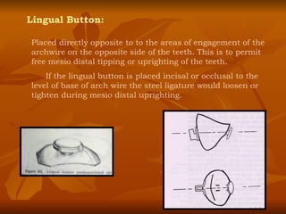 Lingual Button: Placed directly opposite to to the areas of engagement of the archwire on the opposite side of the teeth. This is to permit free mesio distal tipping or uprighting of the teeth. If the lingual button is placed incisal or occlusal to the level of base of arch wire the steel ligature would loosen or tighten during mesio distal uprighting. 