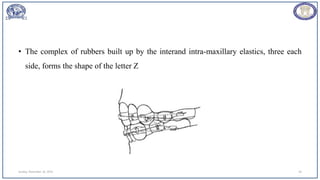 • The complex of rubbers built up by the interand intra-maxillary elastics, three each
side, forms the shape of the letter Z
Sunday, November 26, 2023 34
 