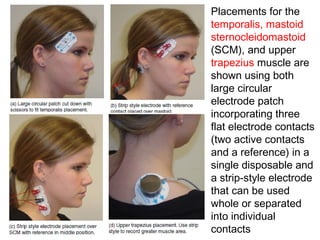 Placements for the
temporalis, mastoid
sternocleidomastoid
(SCM), and upper
trapezius muscle are
shown using both
large circular
electrode patch
incorporating three
flat electrode contacts
(two active contacts
and a reference) in a
single disposable and
a strip-style electrode
that can be used
whole or separated
into individual
contacts
 