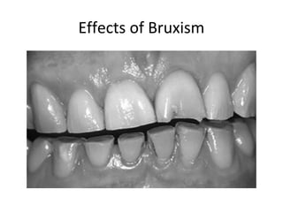 Effects of Bruxism
 