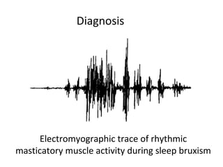 Electromyographic trace of rhythmic
masticatory muscle activity during sleep bruxism
Diagnosis
 