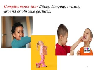 Complex motor tics- Biting, banging, twisting
around or obscene gestures.
Mable_Maria 85
 