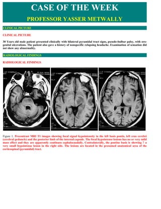CASE OF THE WEEK
                   PROFESSOR YASSER METWALLY
CLINICAL PICTURE

CLINICAL PICTURE

30 Years old male patient presented clinically with bilateral pyramidal tract signs, pseudo-bulbar palsy, with oro-
genital ulcerations. The patient also gave a history of nonspecific relapsing headache. Examination of sensation did
not show any abnormality.

RADIOLOGICAL FINDINGS

RADIOLOGICAL FINDINGS  




Figure 1. Precontrast MRI T1 images showing focal signal hypointensity in the left basis pontis, left crus cerebri
(cerebral peduncle) and the posterior limb of the internal capsule. The focal hypointense lesions has no or very mild
mass effect and they are apparently continuos cephalocaudally. Contralaterally, the pontine basis is showing ? a
very small hypointense lesion in the right side. The lesions are located in the presumed anatomical area of the
corticospinal (pyramidal) tract.
 