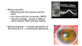 • Retina vasculitis
• Affecting both the arteries and the
veins
• can cause vascular occlusions- BRVO.
• Vascular leakage - results in diffuse
retina edema, CMO and disc edema
• Retinal ischemia --> neovascularization of
the retina & iris --> neovascular glaucoma.
 