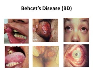 Behcet’s Disease (BD)
 