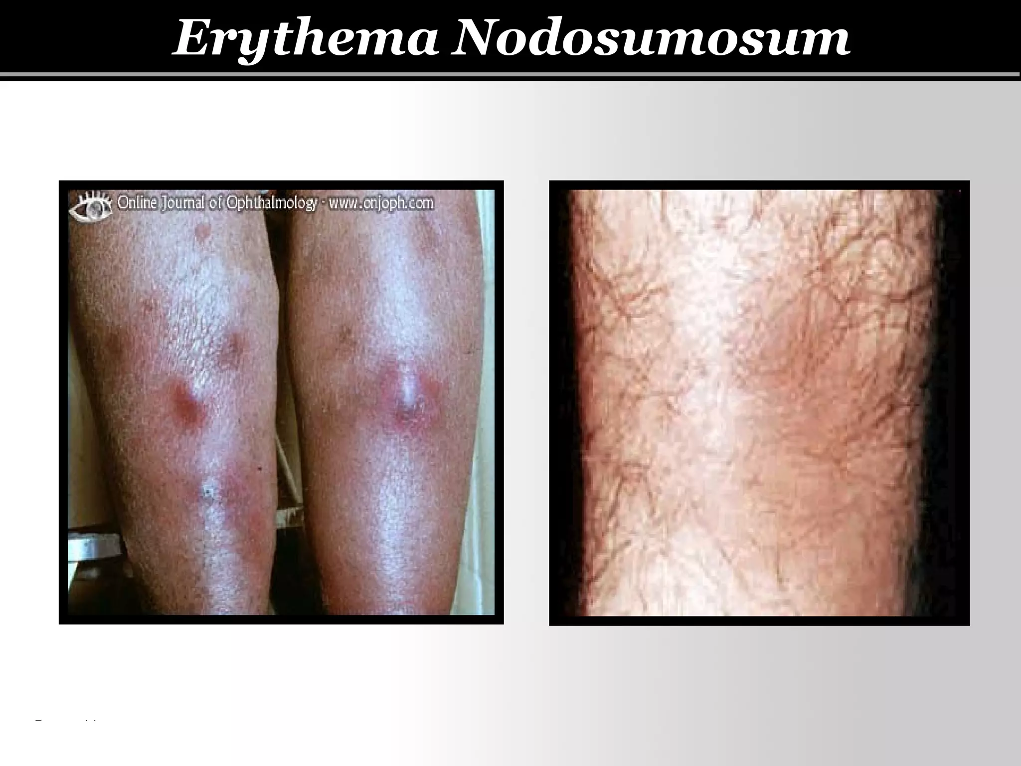 Behcet’s disease | PPT