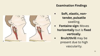 11
Examination Findings
Soft, elastic, non-
tender, pulsatile
swelling.
Fontaine sign: Moves
horizontally but is fixed
vertically.
Bruit/thrill may be
present due to high
vascularity.
 