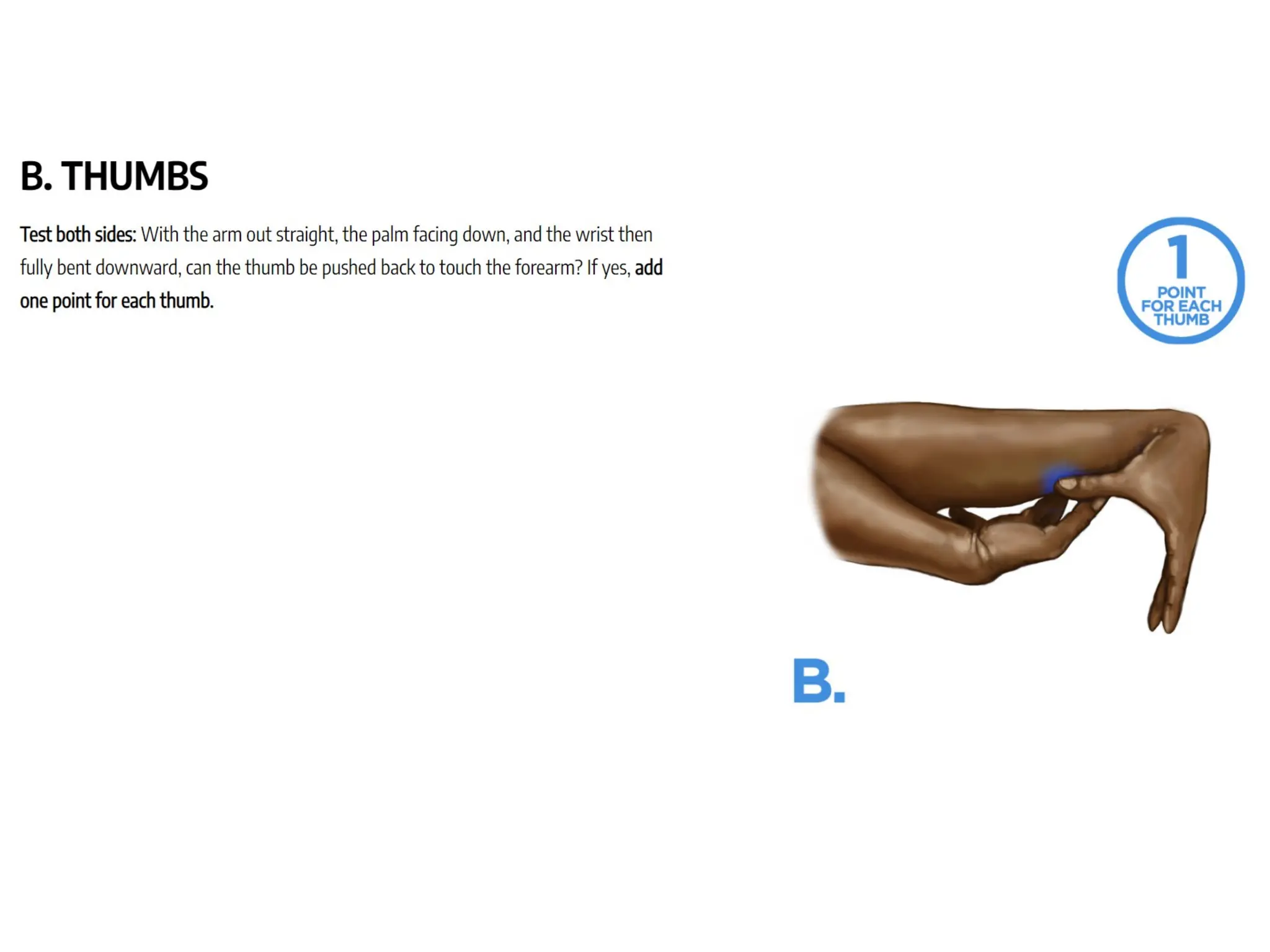 BEIGHTON SCORE FOR HYPERMOBILE SYNDROME,