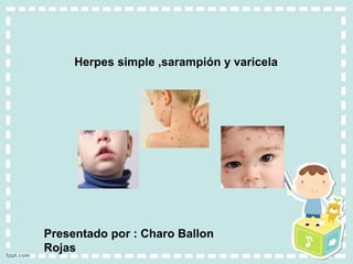Presentado por : Charo Ballon
Rojas
Herpes simple ,sarampión y varicela
 