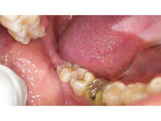 Mission to save teeth in Belize Nov '13