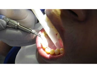 Mission to save teeth in Belize Nov '13