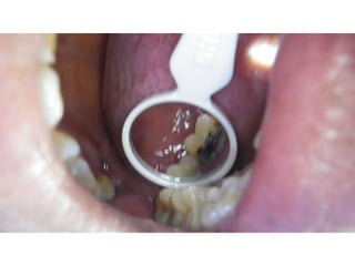 Mission to save teeth in Belize Nov '13