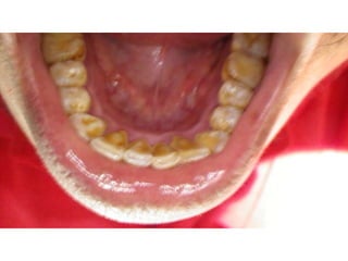 Mission to save teeth in Belize Nov '13