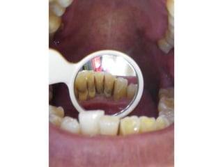 Mission to save teeth in Belize Nov '13