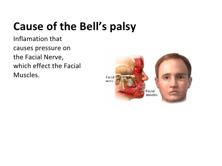Bell S Palsy Bell S Palsy