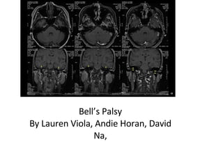 Bell’s Palsy By Lauren Viola, Andie Horan, David Na, 