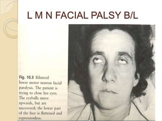 L M N FACIAL PALSY B/L
