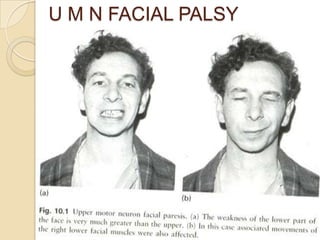 U M N FACIAL PALSY
