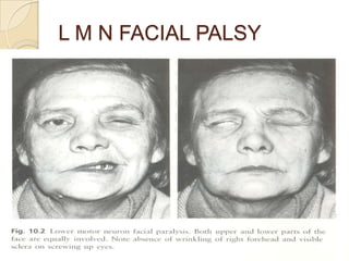 L M N FACIAL PALSY