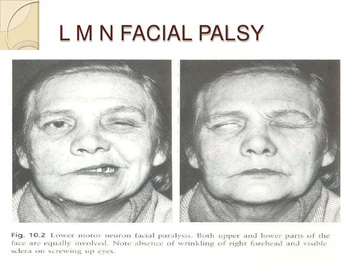 Bell’s palsy